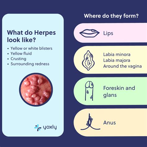 herpee|what does herpes feel like.